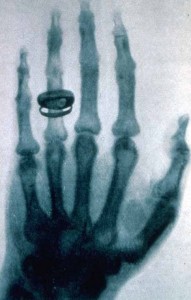 Röntgenaufnahme von Wilhelm Röntgen von Albert von Köllikers Hand